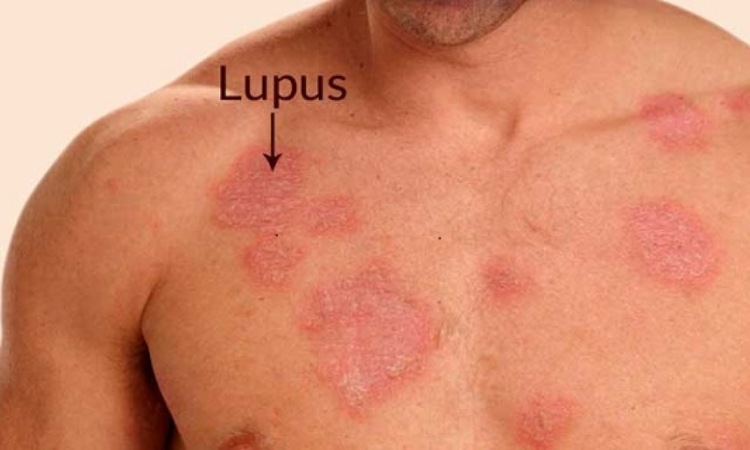 Un lupus visibile sulla pelle
