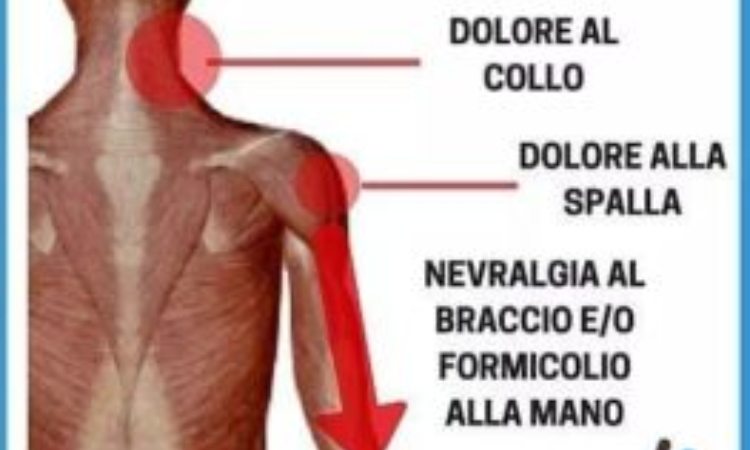 La cervicobrachialgia vista in disegno