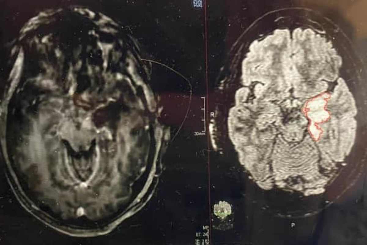 tumore al cervello