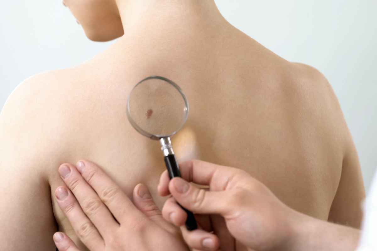 Tutti questi sono segnali di un tumore della pelle, i dettagli