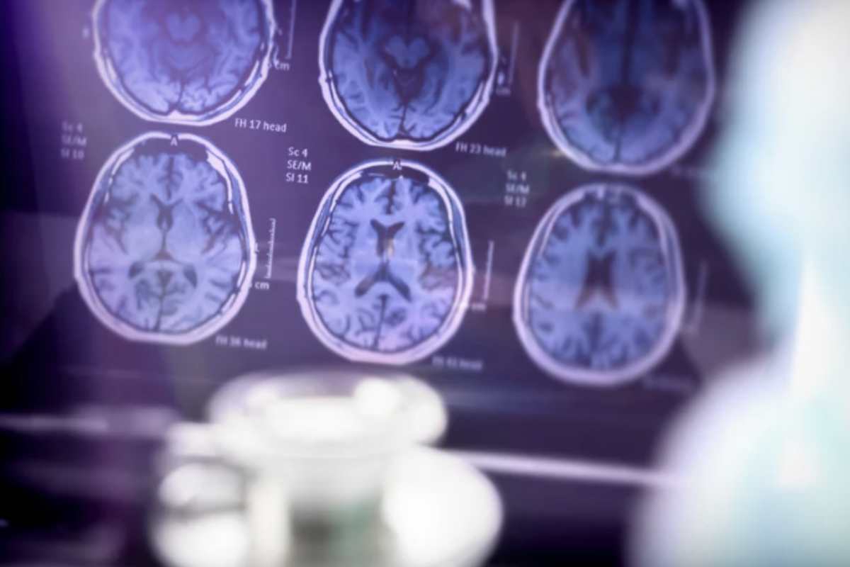 Nel 2025, la ricerca sull’Alzheimer ha fatto passi avanti significativi. Recentemente è stato sviluppato un farmaco rivoluzionario in grado di eliminare